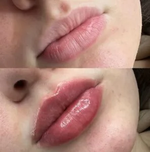 Lip fillers in delhi